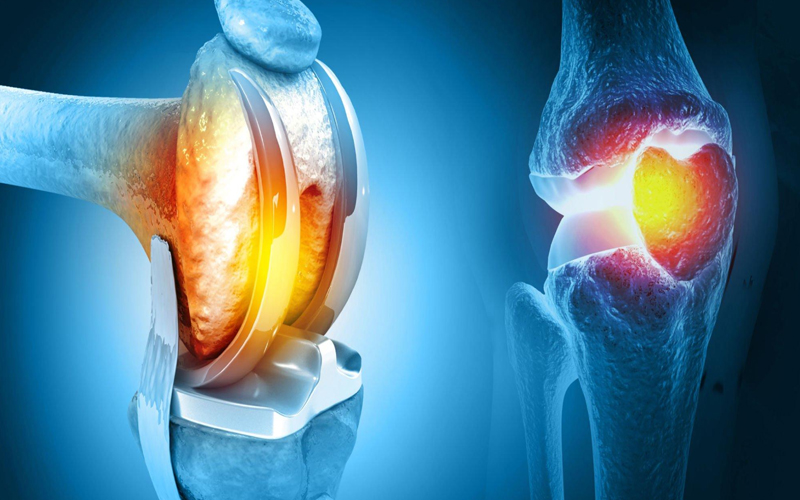 What is Juvenile Rheumatoid Arthritis