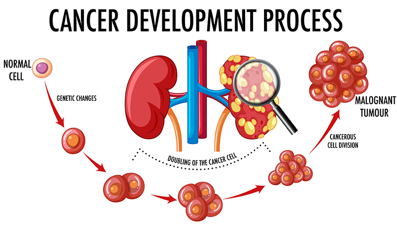 Kidney Cancer Stages Explained: Understanding the Diagnosis