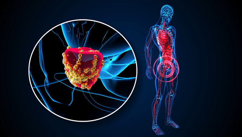 Adenocarcinoma Glandular Cancer Treatment in India