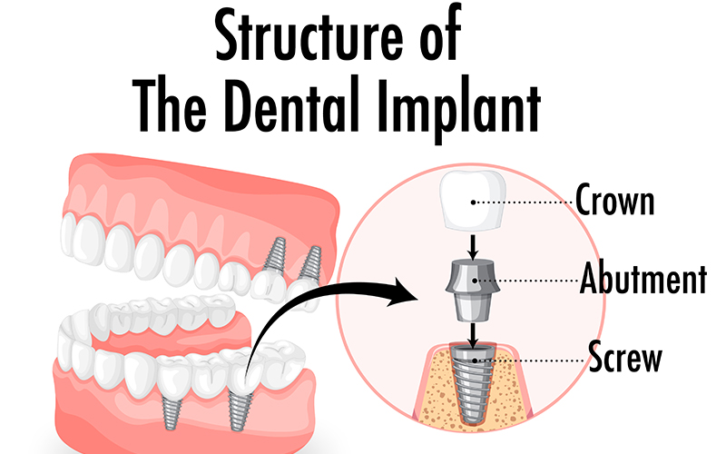 Discover the Best Dental Implants Near Me: A Comprehensive Guide to Your Options