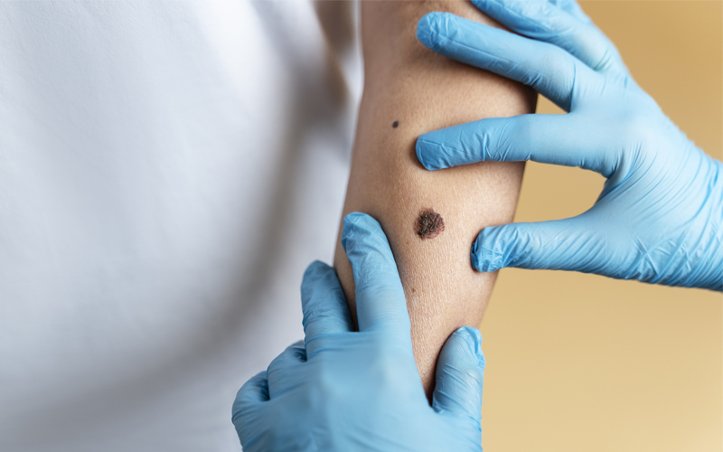 Melanoma Treatment in India